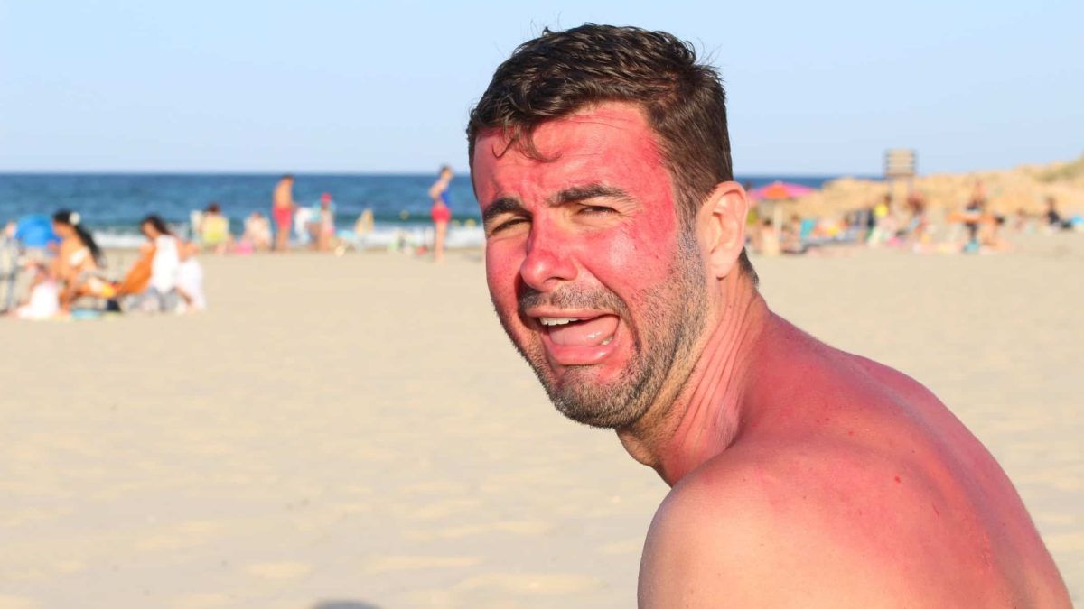 Unhappy sunburnt man at the beach making painful face